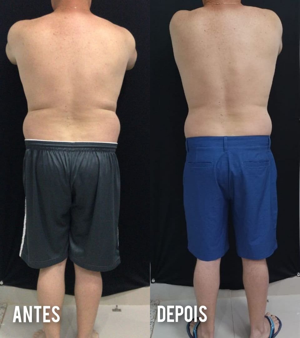 Evolução real de paciente: antes e depois, vista posterior