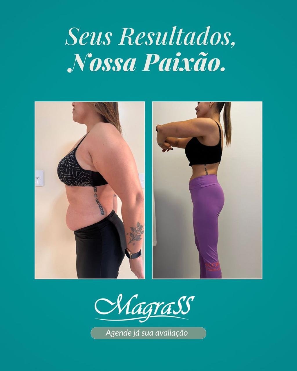 Evolução real de paciente Magrass: antes e depois, vista lateral